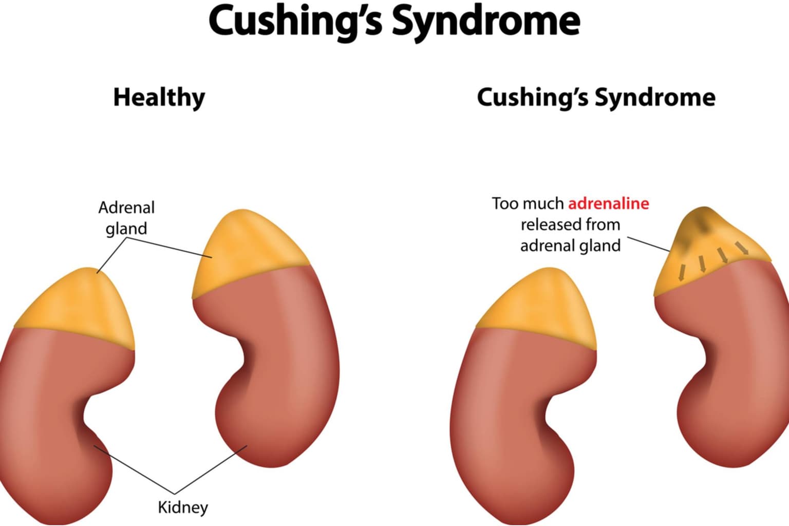 Sindromul Cushing: cauze, simptome, diagnostic, tratament