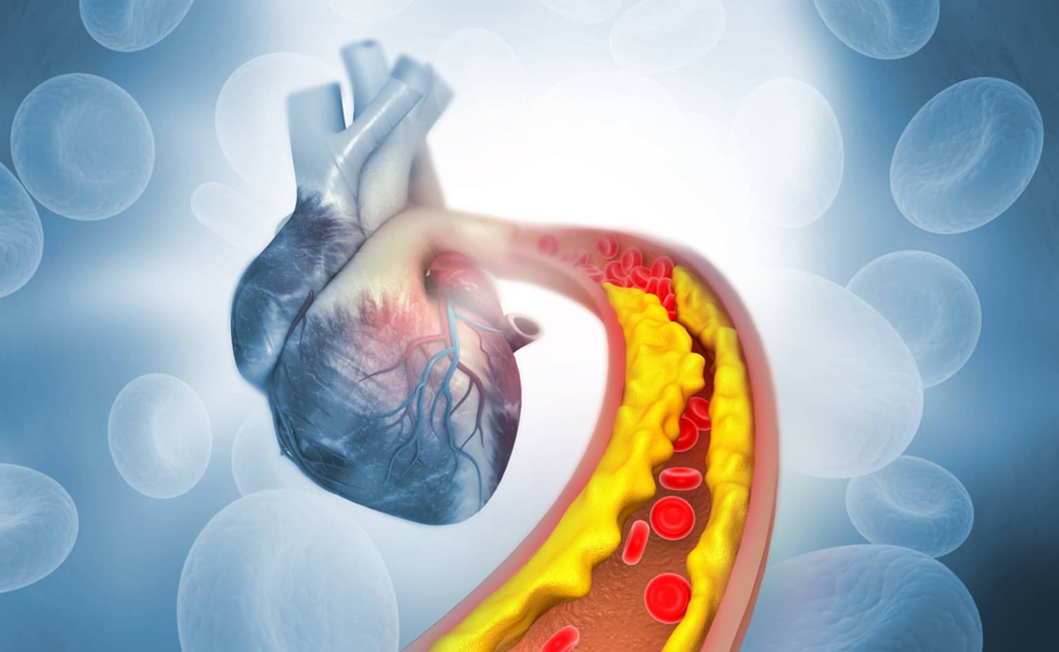 Ateroscleroza: Ce este, cauze, complicații, diagnostic