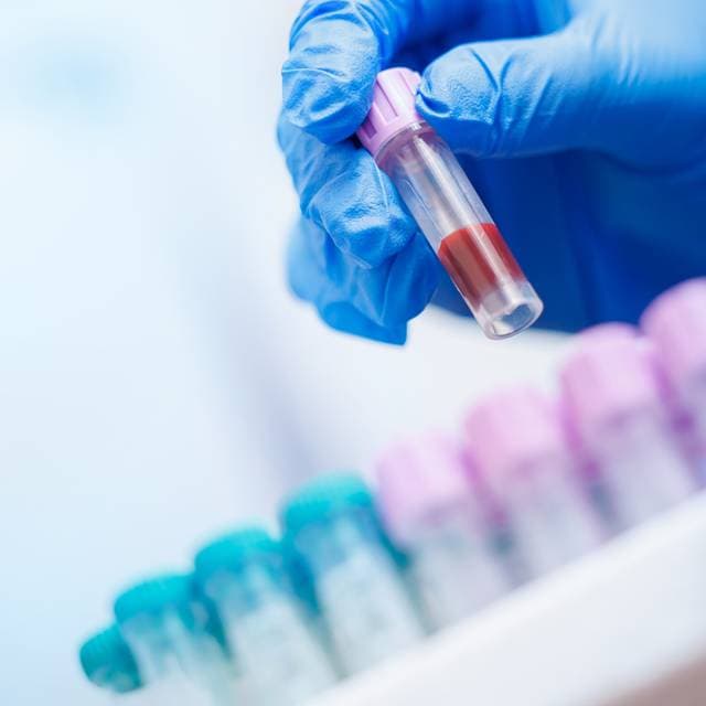 Analize pentru monitorizarea inflamației: de ce sunt importante?