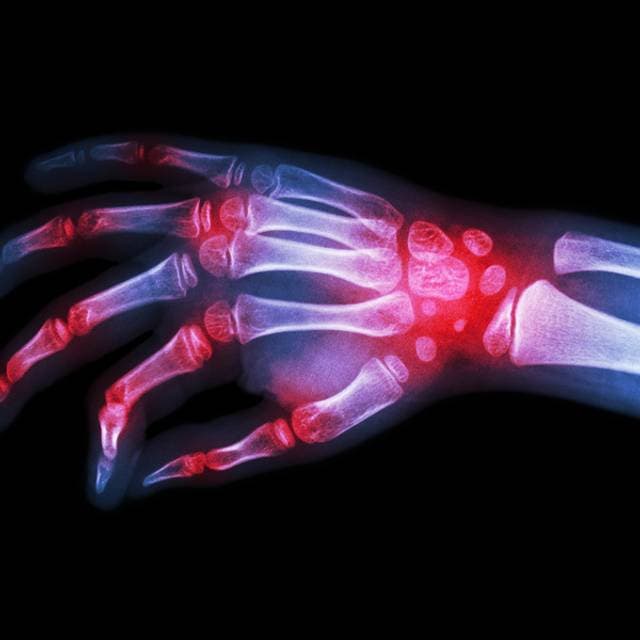 Reumatismul articular acut (RAA)