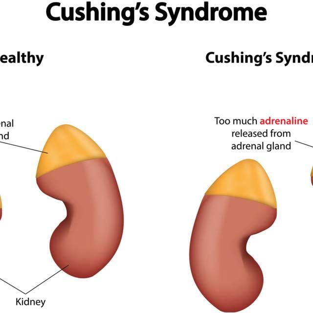 Sindromul Cushing: cauze, simptome, diagnostic, tratament